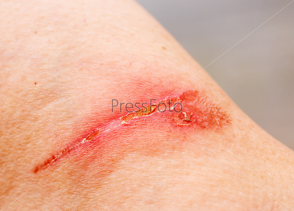 A burn scar that is partly healed