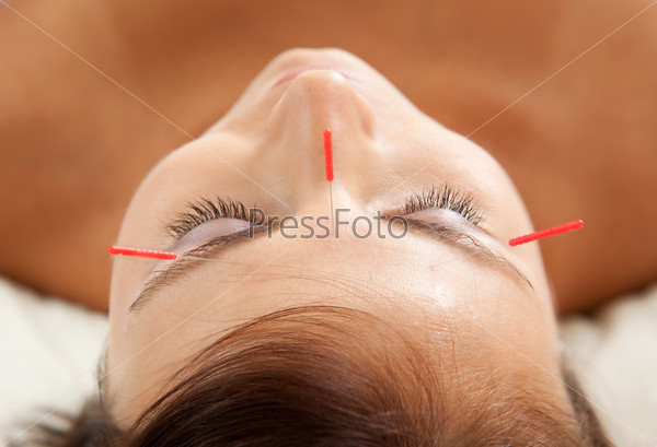 Anti-aging acupuncture treatment on young attractive female patient