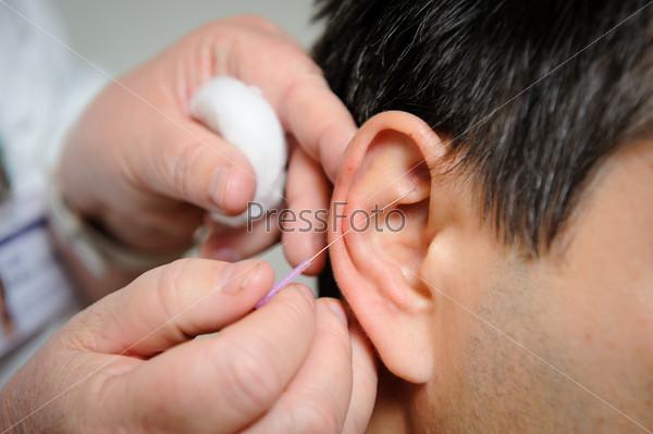 Acupuncture. Needles being inserted into a patient\'s ear