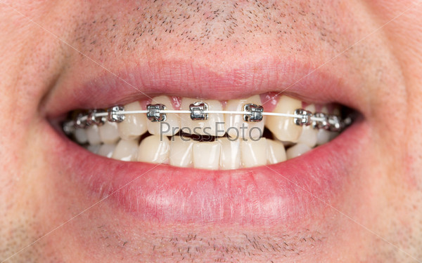 Close-up of braces on the teeth of the upper jaw with unshaven men