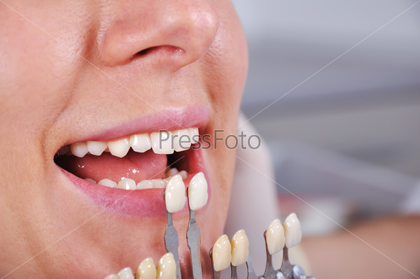 Выбор оттенка для отбеливания зубов