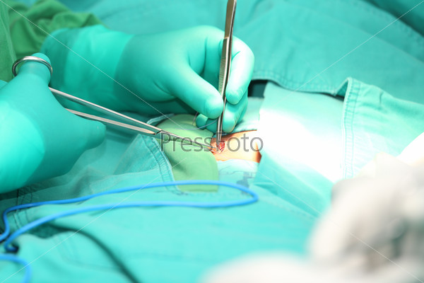 Surgeon hands suturing an hernia