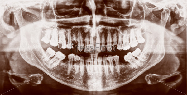 Рентгеновское изображение человеческих зубов