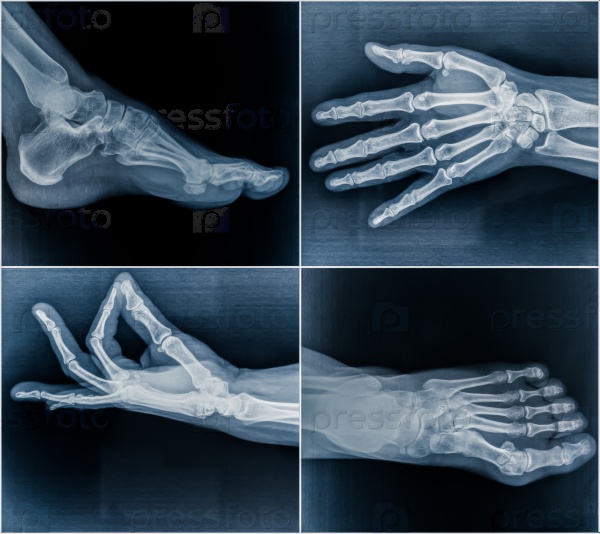 Рентгены рук и ног