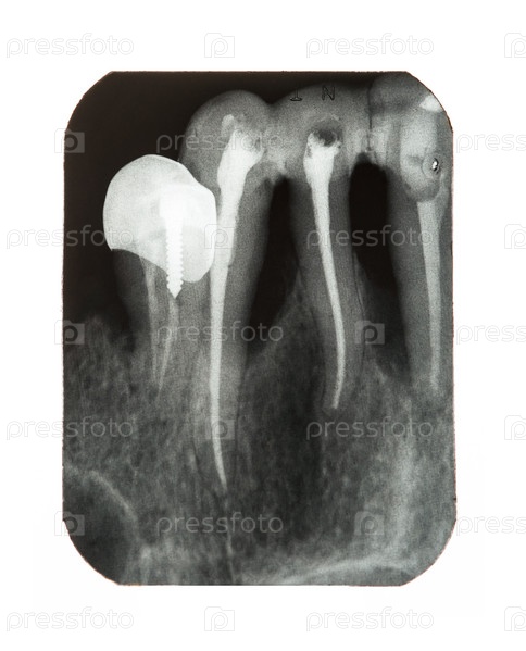Периодонтит радиовизиография. Рентген зуба что это. Рентген зуба что это. Периодонтит радиовизиография. Рентгеновский снимок зуба.
