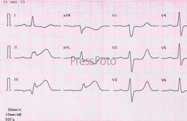 Инфаркт миокарда, диагностика | Кафедра внутрішньої медицини № 3 та ендокринології