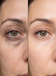 Темные круги под глазами до и после крупным планом - artshock