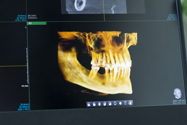 Экран компьютера показывает цветное объемное 3D-сканирование челюстной кости и зубных дуг. Стоматологический - Pazemin
