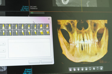 Экран компьютера, демонстрирующий программное обеспечение для 3D-дентальной CBCT с объемной визуализацией черепа и выделением зубов. Стоматологический - Pazemin