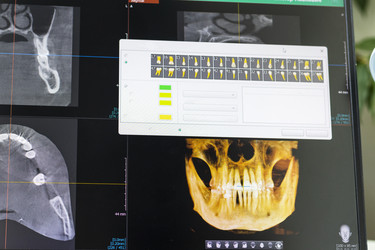 Экран компьютера, демонстрирующий программное обеспечение для 3D-дентальной CBCT с объемной визуализацией черепа и выделением зубов. Стоматолог - Pazemin