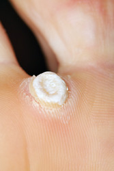 Falling off wart on sole of female feet. Wart - benign skin - paha_l